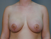 Patient # 95212 After Photo # 2