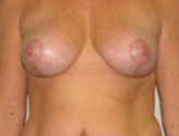 Patient # 66784 After Photo # 2