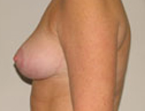 Patient # 66784 After Photo # 4