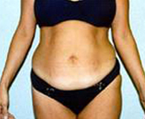 Patient # 90029 Before Photo # 1