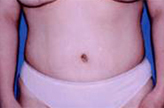 Patient # 33787 After Photo # 2