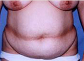 Patient # 33787 Before Photo # 1