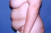 Patient # 33787 Before Photo # 3