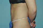 Patient # 86297 After Photo # 4