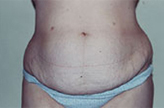 Patient # 72786 Before Photo # 1