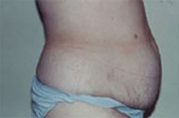 Patient # 72786 Before Photo # 3