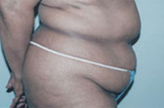 Patient # 26917 Before Photo # 3