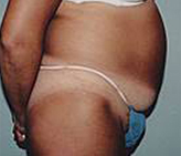 Patient # 65674 Before Photo # 1