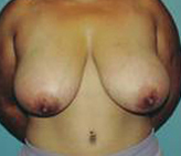 Patient # 31364 Before Photo # 1