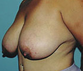 Patient # 31364 Before Photo # 3