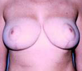 Patient # 96667 After Photo # 2