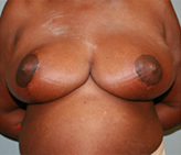 Patient # 35132 After Photo # 2