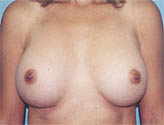 Patient # 58774 After Photo # 2
