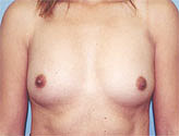 Patient # 58774 Before Photo # 1