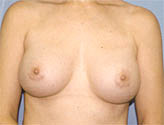 Patient # 65600 After Photo # 2