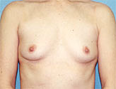 Patient # 65600 Before Photo # 1