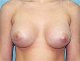 Patient # 18692 After Photo # 2