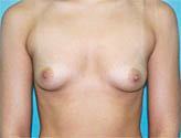 Patient # 18692 Before Photo # 1