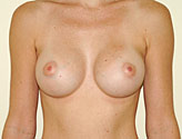 Patient # 33891 After Photo # 2