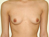 Patient # 17117 Before Photo # 1
