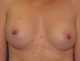 Patient # 45865 After Photo # 2