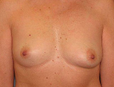 Patient # 45865 Before Photo # 1