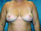 Patient # 23815 After Photo # 2