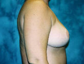 Patient # 23815 After Photo # 4