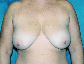 Patient # 23815 Before Photo # 1