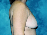 Patient # 23815 Before Photo # 3