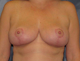 Patient # 47044 After Photo # 2