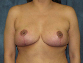 Patient # 88095 After Photo # 2