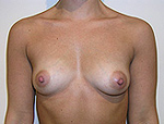 Patient # 13486 Before Photo # 1