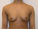 Patient # 90314 Before Photo # 1