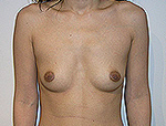 Patient # 61869 Before Photo # 1
