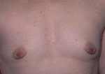 Patient # 99329 Before Photo # 1