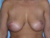 Patient # 30974 After Photo # 2