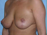 Patient # 30974 After Photo # 4