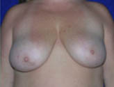 Patient # 69886 Before Photo # 1