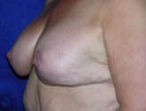 Patient # 29585 After Photo # 4