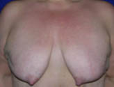 Patient # 29585 Before Photo # 1