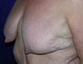 Patient # 29585 Before Photo # 3