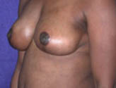 Patient # 87777 After Photo # 4