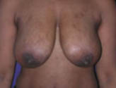 Patient # 87777 Before Photo # 1