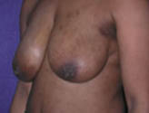 Patient # 87777 Before Photo # 3