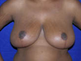 Patient # 48728 After Photo # 2