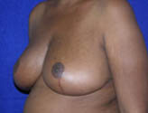 Patient # 48728 After Photo # 4