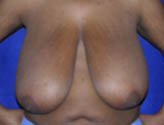 Patient # 48728 Before Photo # 1