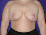 Patient # 61270 After Photo # 2