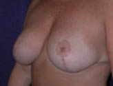 Patient # 68049 After Photo # 4